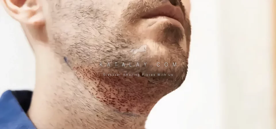 Beard Transplant in Turkey