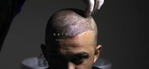 Men Hair Transplant in Turkey