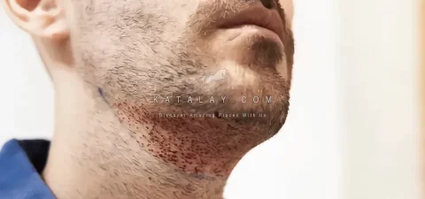 Beard Transplant in Turkey