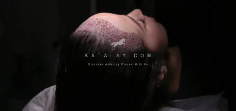 Women Hair Transplant in Turkey