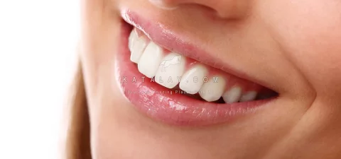 Hollywood Smile in Turkey