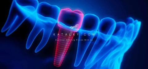 Dental Implants in Turkey